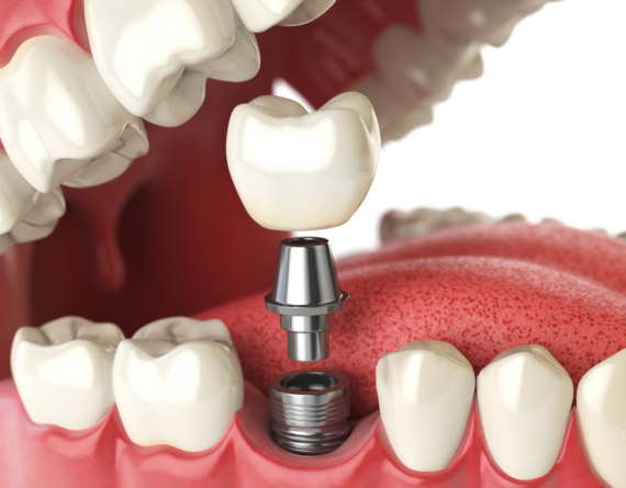 Smmmile’s Top 5 Reasons to Opt for a Dental Implant
